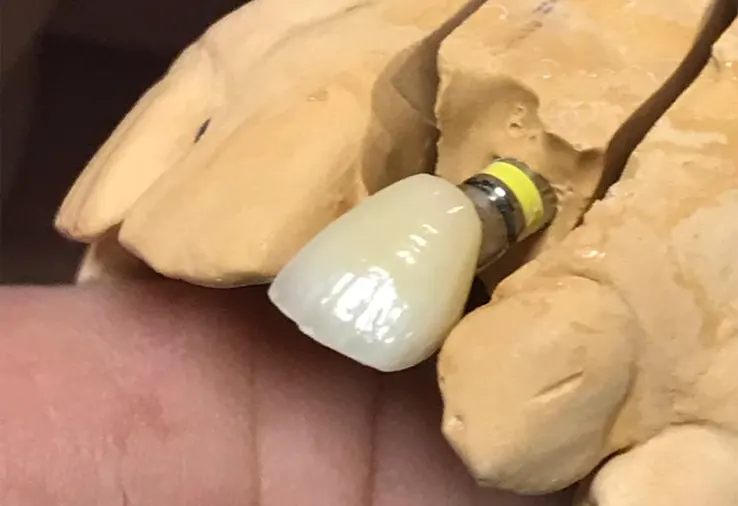 Implant dentaire fixe