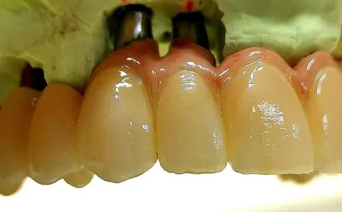 Prothèse dentaire fixe