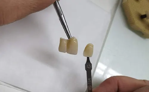 Réparation d'une prothèse dentaire