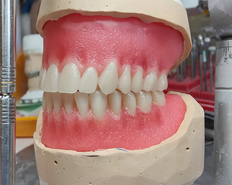 Prothèse dentaire amovible terminée