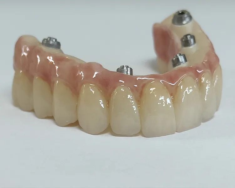 Bridge total supérieur en zircon sur 5 implants